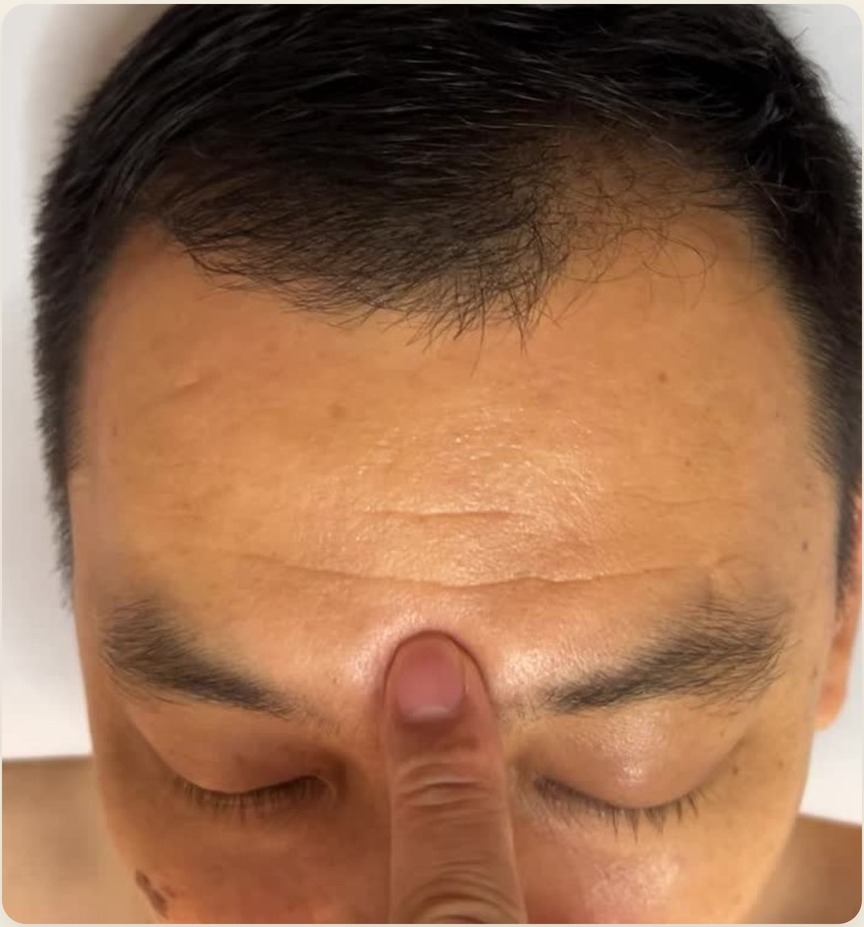 Finger pressing Yin Tang EX-HN3 in the centre of the forehead, between the eyebrows